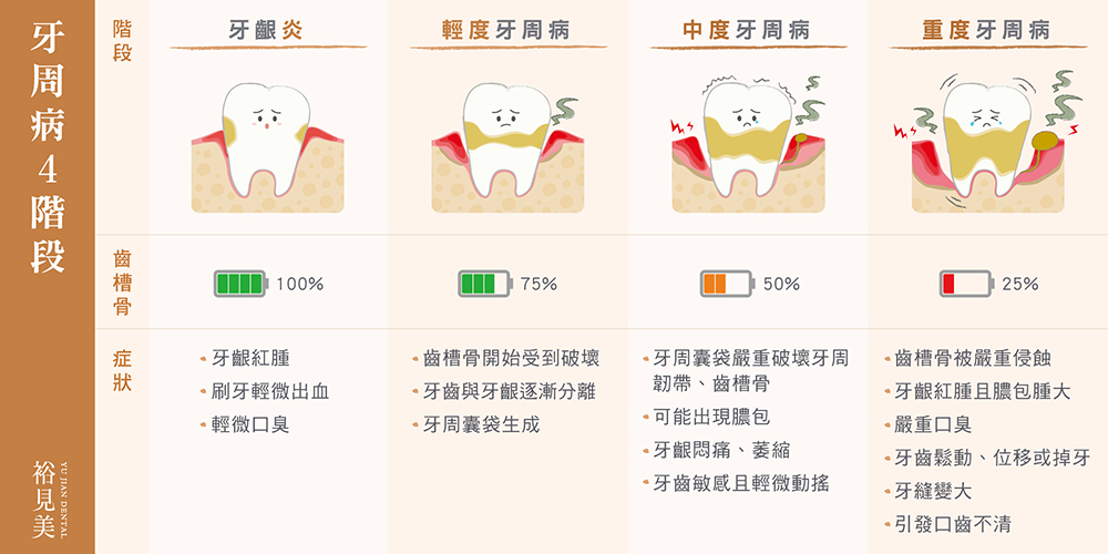 牙周病4大階段(牙齦炎、輕度牙周病、中度牙周病、重度牙周病)