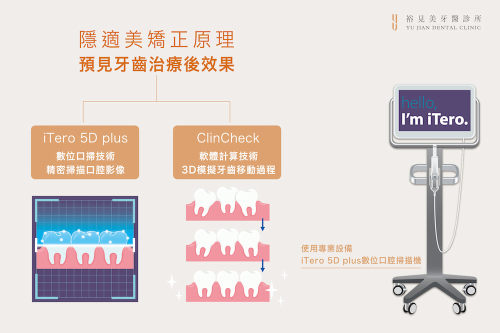 數位隱適美矯正：iTero 5D plus數位口腔技術、Clin Click軟體技術技術
