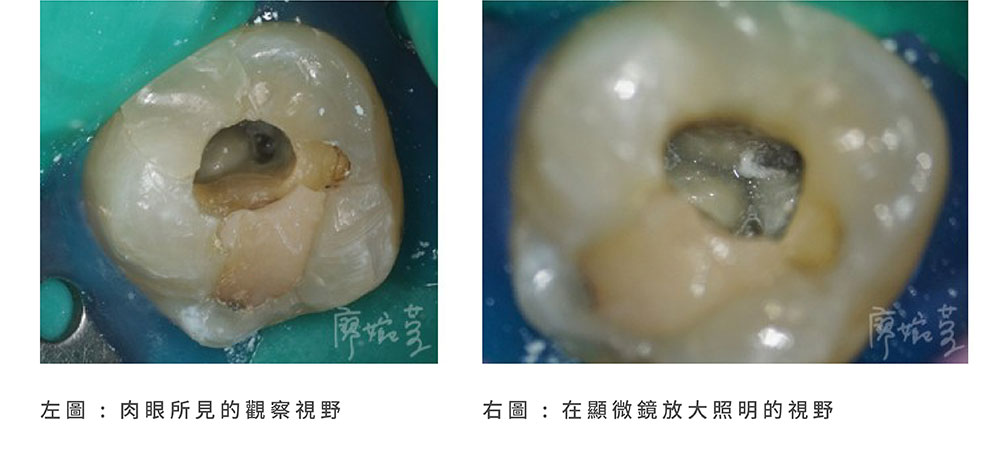 一般根管治療、顯微根管治療比較