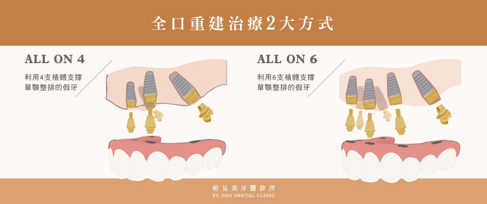 全口重建2大方式：ALL-ON-4、ALL-ON-6