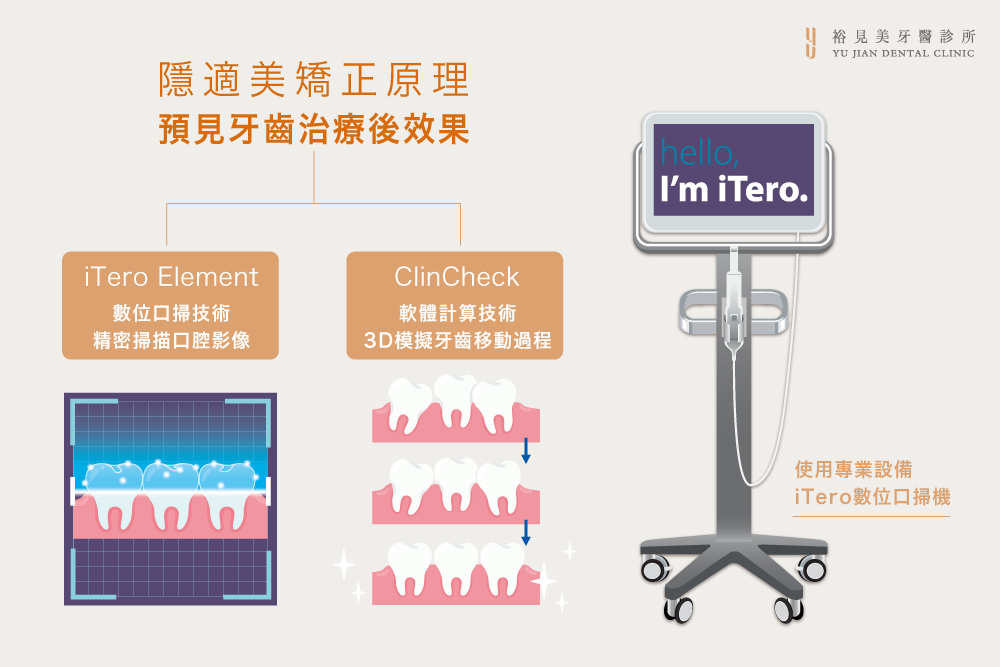 數位隱適美矯正:iTero Element數位口腔技術、Clin Click軟體技術技術