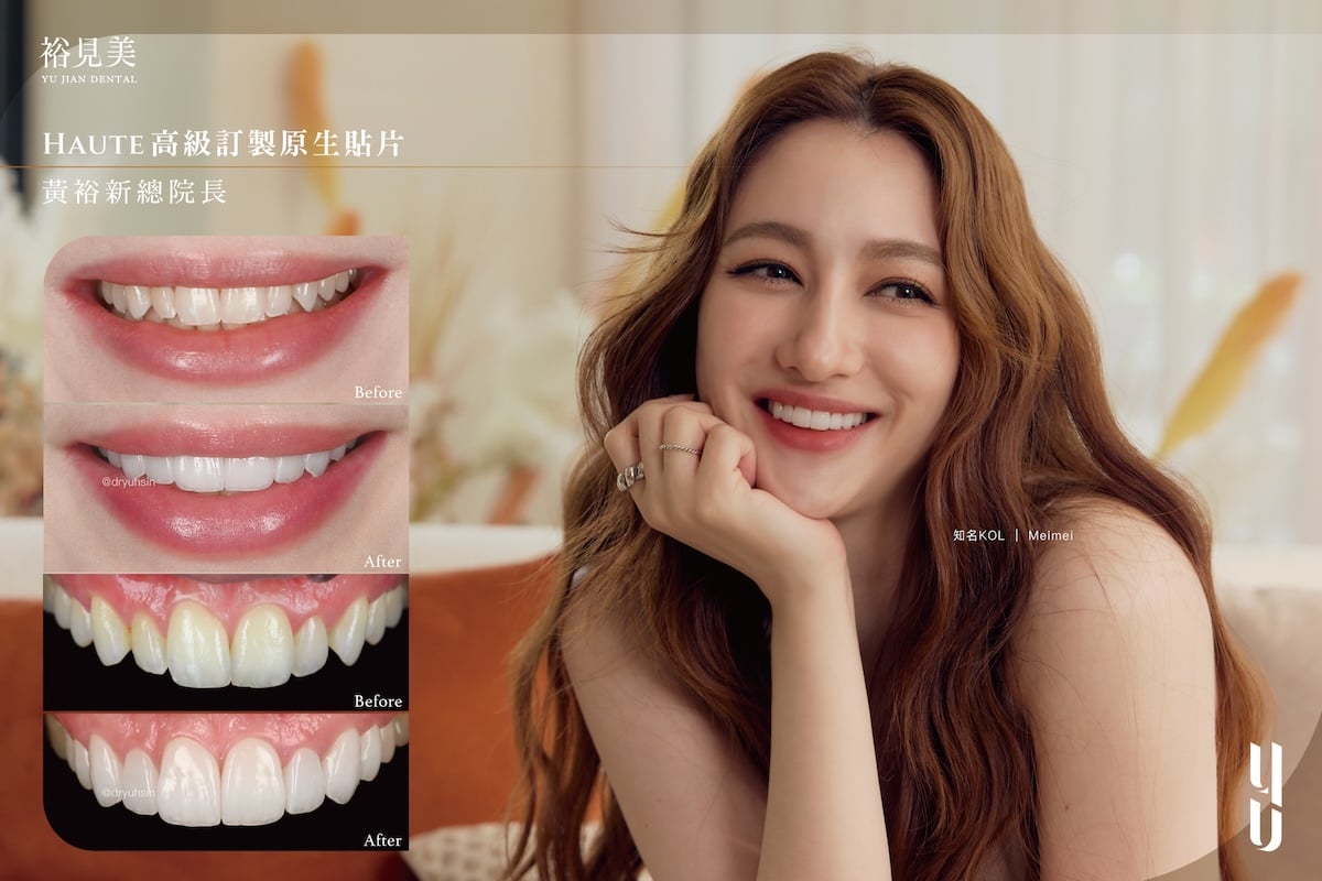 陶瓷美白貼片案例分享