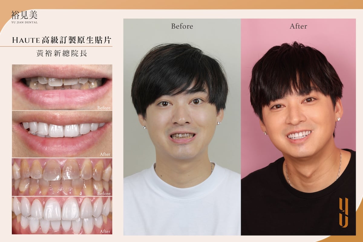 陶瓷美白貼片案例分享