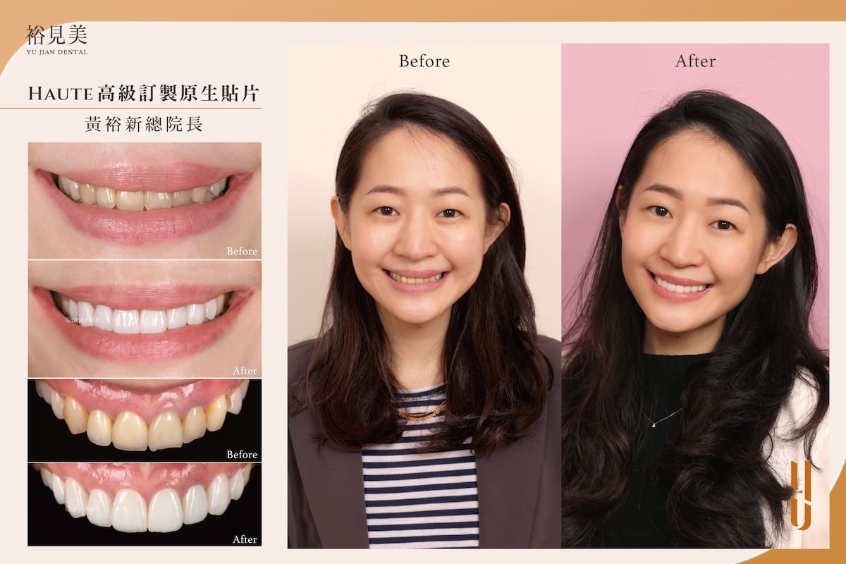 陶瓷美白貼片案例分享