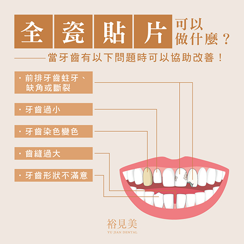 全瓷貼片適合哪些人