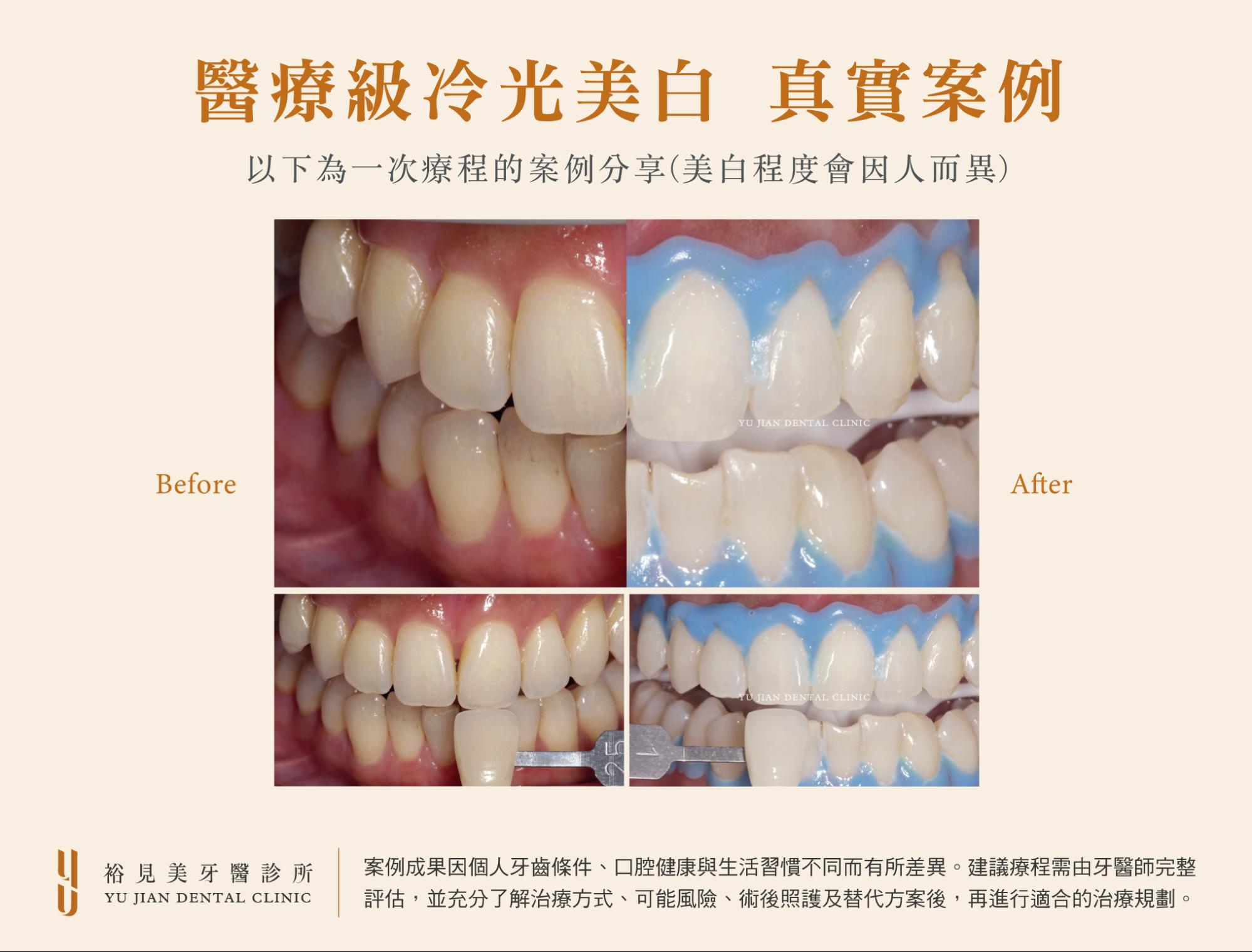 裕見美冷光美白真實案例