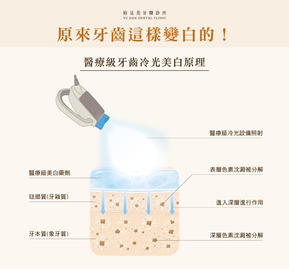 醫療級牙齒冷光美白原理：冷光照射催化醫療級美白藥劑，深入牙本質分解深層色素，改變的是色素分子而不是牙齒形狀