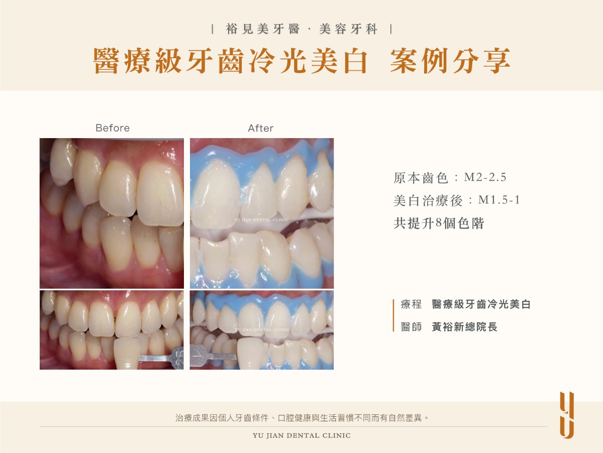 醫療級牙齒冷光美白案例一：療程前齒色 M2-2.5，美白治療後 M1.5-1，共提升 8 個色階，醫師黃裕新總院長
