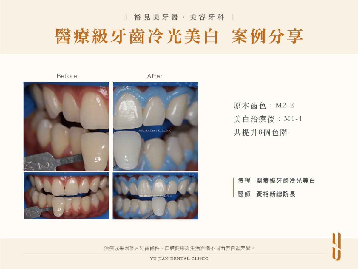 醫療級牙齒冷光美白案例二：療程前齒色 M2-2，美白治療後 M1-1，共提升 8 個色階，醫師黃裕新總院長