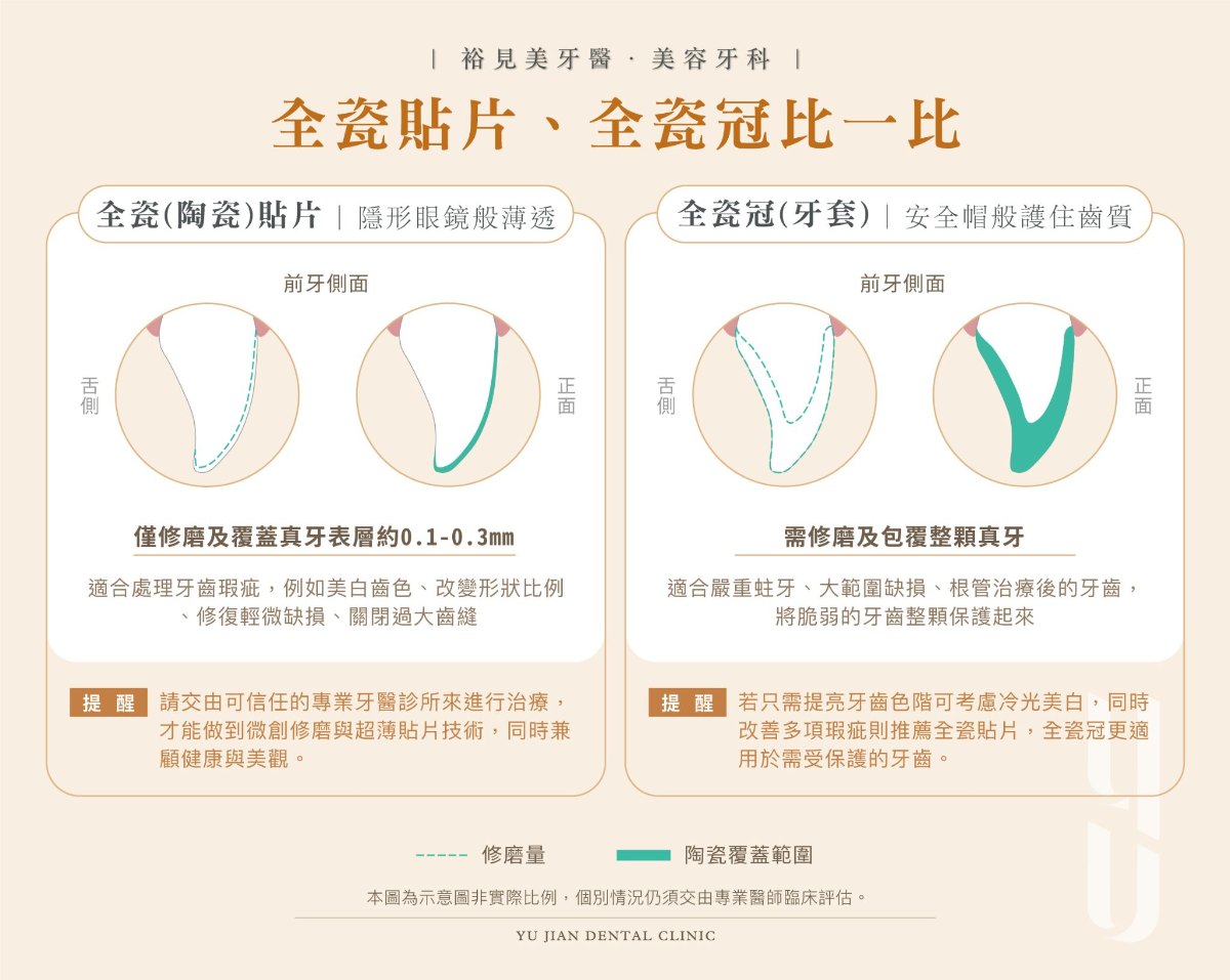 全瓷貼片與全瓷冠比一比：陶瓷貼片僅修磨及覆蓋唇側表面，全瓷冠則完整包覆整顆牙齒