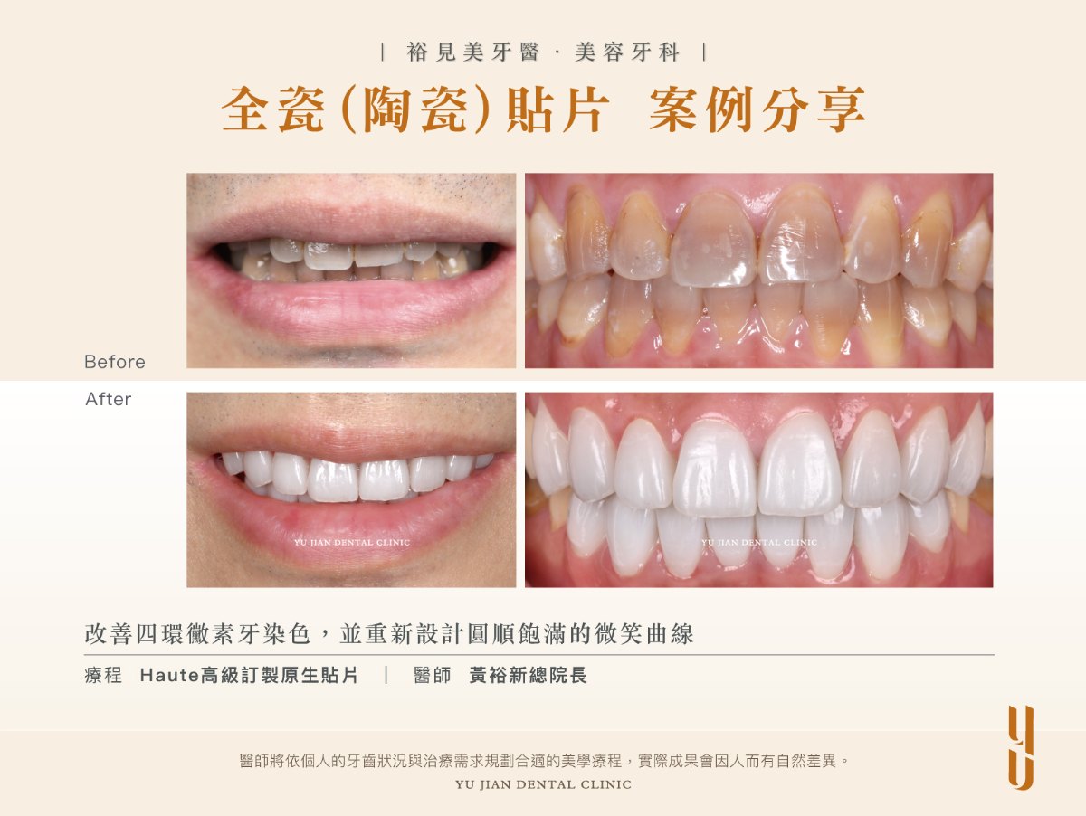 陶瓷貼片療程前後對照，改善四環黴素牙染色並重新設計微笑曲線，由黃裕新總院長以 Haute 高級訂製原生貼片施作