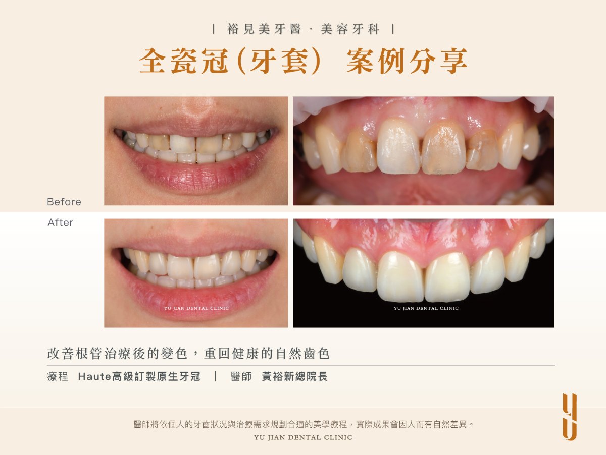 全瓷冠療程前後對照，改善根管治療後的單顆牙齒變色，由黃裕新總院長施作