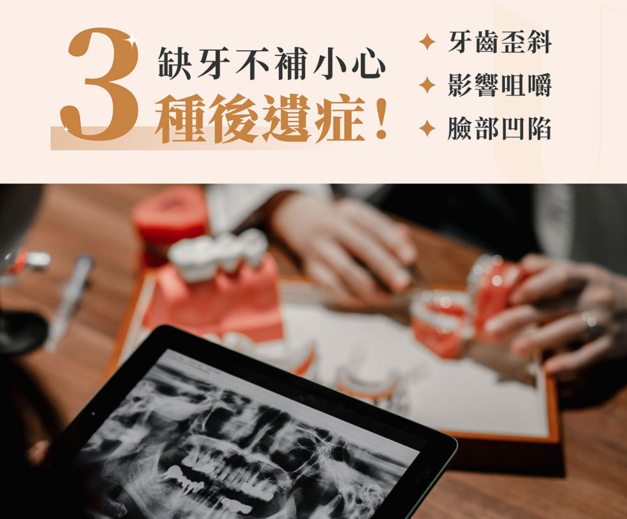 缺牙不補的後遺症